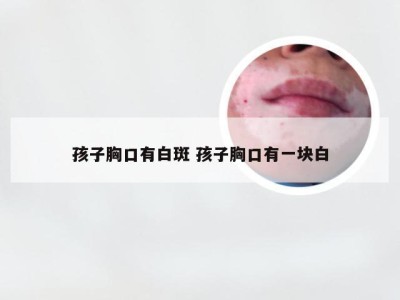 孩子胸口有白斑 孩子胸口有一块白