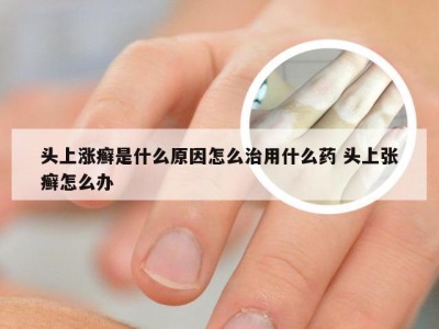 头上涨癣是什么原因怎么治用什么药 头上张癣怎么办