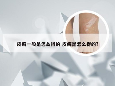 皮癣一般是怎么得的 皮癣是怎么得的?