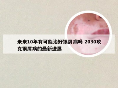 未来10年有可能治好银屑病吗 2030攻克银屑病的最新进展