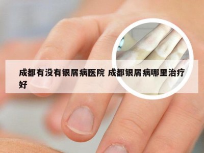 成都有没有银屑病医院 成都银屑病哪里治疗好