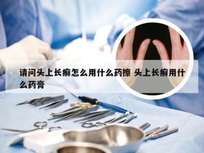 请问头上长癣怎么用什么药擦 头上长癣用什么药膏