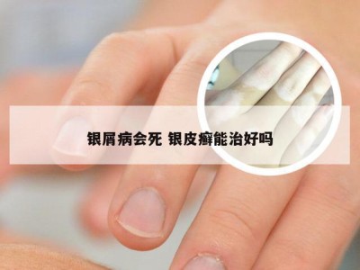 银屑病会死 银皮癣能治好吗