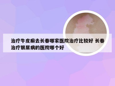 治疗牛皮癣去长春哪家医院治疗比较好 长春治疗银屑病的医院哪个好