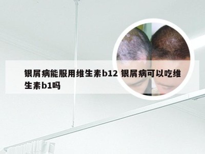 银屑病能服用维生素b12 银屑病可以吃维生素b1吗