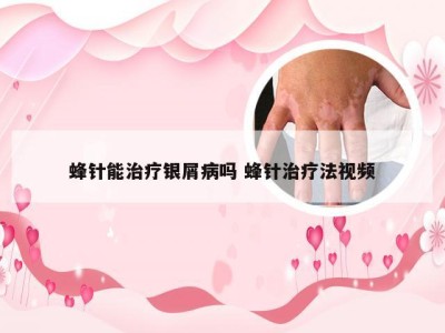 蜂针能治疗银屑病吗 蜂针治疗法视频