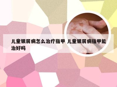 儿童银屑病怎么治疗指甲 儿童银屑病指甲能治好吗