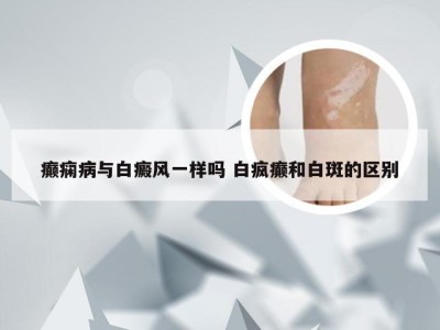 癫痫病与白癜风一样吗 白疯癫和白斑的区别