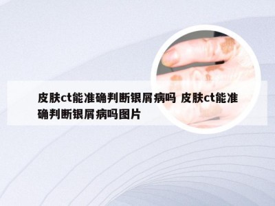 皮肤ct能准确判断银屑病吗 皮肤ct能准确判断银屑病吗图片