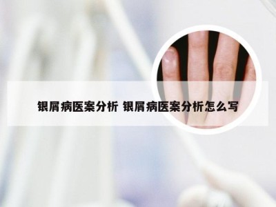 银屑病医案分析 银屑病医案分析怎么写