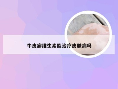 牛皮癣维生素能治疗皮肤病吗