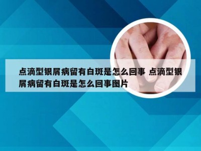 点滴型银屑病留有白斑是怎么回事 点滴型银屑病留有白斑是怎么回事图片