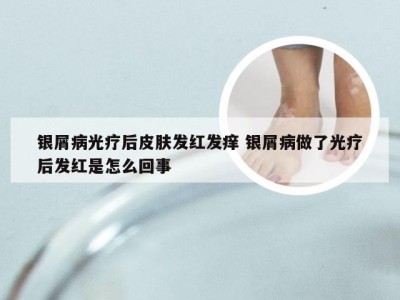 银屑病光疗后皮肤发红发痒 银屑病做了光疗后发红是怎么回事