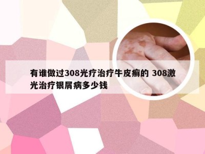 有谁做过308光疗治疗牛皮癣的 308激光治疗银屑病多少钱