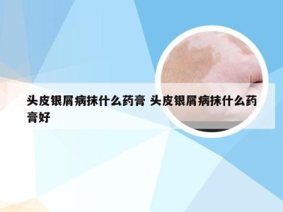 头皮银屑病抹什么药膏 头皮银屑病抹什么药膏好