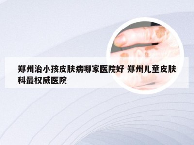 郑州治小孩皮肤病哪家医院好 郑州儿童皮肤科最权威医院