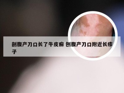 剖腹产刀口长了牛皮癣 刨腹产刀口附近长疹子