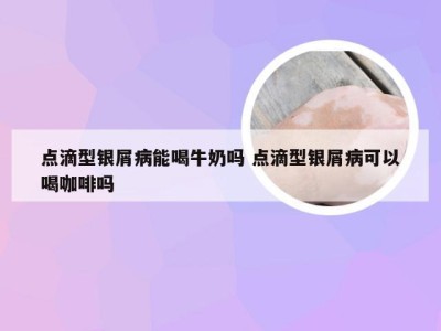 点滴型银屑病能喝牛奶吗 点滴型银屑病可以喝咖啡吗