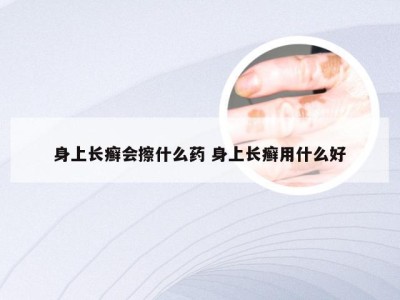 身上长癣会擦什么药 身上长癣用什么好