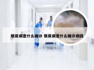 银屑病查什么确诊 银屑病查什么确诊病因