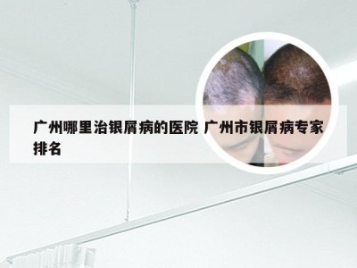 广州哪里治银屑病的医院 广州市银屑病专家排名