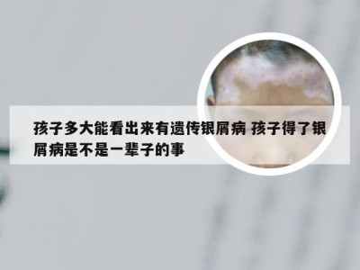 孩子多大能看出来有遗传银屑病 孩子得了银屑病是不是一辈子的事