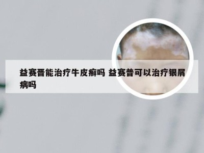 益赛晋能治疗牛皮癣吗 益赛普可以治疗银屑病吗