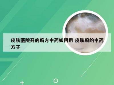 皮肤医院开的癣方中药如何用 皮肤癣的中药方子