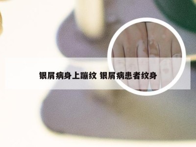 银屑病身上蹦纹 银屑病患者纹身