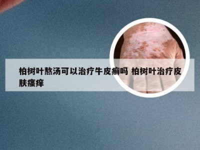 柏树叶熬汤可以治疗牛皮癣吗 柏树叶治疗皮肤瘙痒