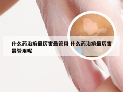 什么药治癣最厉害最管用 什么药治癣最厉害最管用呢