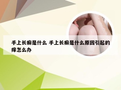 手上长癣是什么 手上长癣是什么原因引起的痒怎么办