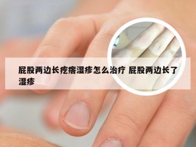 屁股两边长疙瘩湿疹怎么治疗 屁股两边长了湿疹