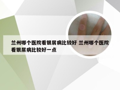 兰州哪个医院看银屑病比较好 兰州哪个医院看银屑病比较好一点