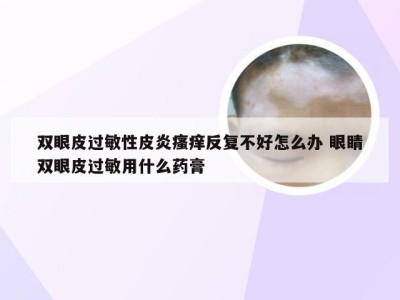 双眼皮过敏性皮炎瘙痒反复不好怎么办 眼睛双眼皮过敏用什么药膏