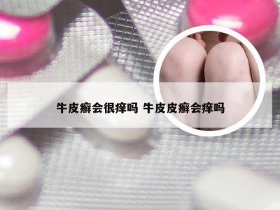 牛皮癣会很痒吗 牛皮皮癣会痒吗