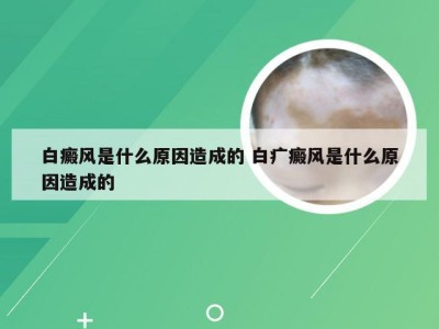 白癜风是什么原因造成的 白疒癜风是什么原因造成的