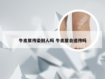 牛皮屑传染别人吗 牛皮屑会遗传吗