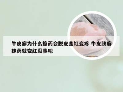 牛皮癣为什么擦药会脱皮变红变疼 牛皮肤癣抹药就变红没事吧