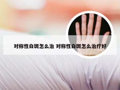 对称性白斑怎么治 对称性白斑怎么治疗好