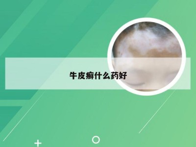 牛皮癣什么药好