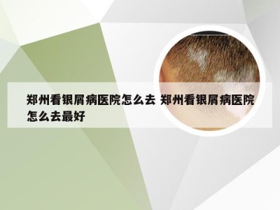 郑州看银屑病医院怎么去 郑州看银屑病医院怎么去最好