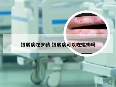 银屑病吃罗勒 银屑病可以吃螺蛳吗