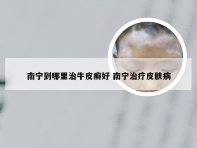 南宁到哪里治牛皮癣好 南宁治疗皮肤病