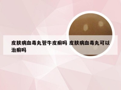 皮肤病血毒丸管牛皮癣吗 皮肤病血毒丸可以治癣吗