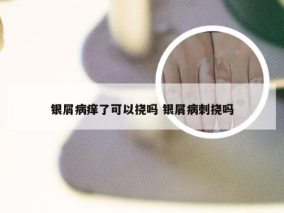 银屑病痒了可以挠吗 银屑病刺挠吗