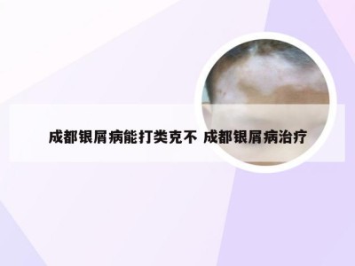 成都银屑病能打类克不 成都银屑病治疗