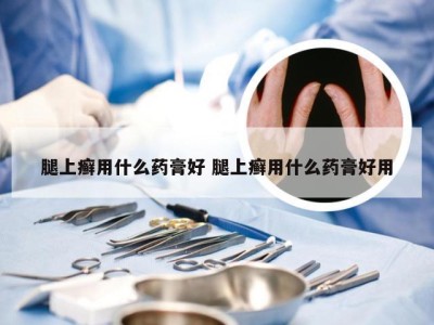 腿上癣用什么药膏好 腿上癣用什么药膏好用