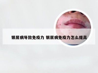 银屑病导致免疫力 银屑病免疫力怎么提高