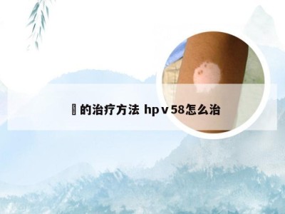 廯的治疗方法 hpⅴ58怎么治